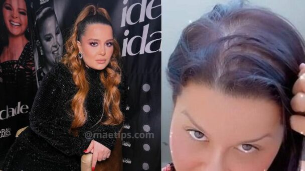 Maiara, da dupla com Maraísa, é diagnosticada com alopecia, condição que causa a queda de cabelo