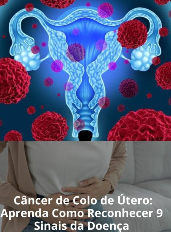 Câncer de Colo de Útero: Aprenda Como Reconhecer 9 Sinais da Doença ...